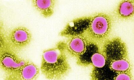 인간에서 코로나 바이러스의 증상은 무엇입니까?